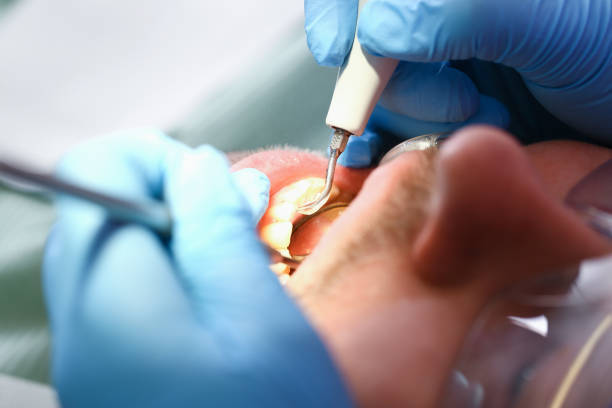 Emergency Dental Filling Replacement in WY