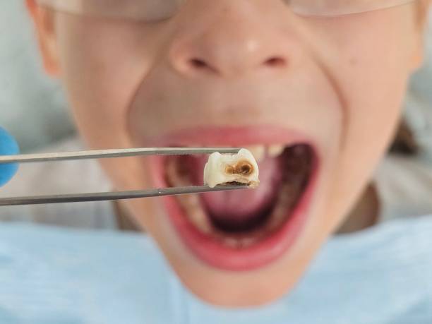 Best Root Canal Emergency Dentist  in Ranchester, WY
